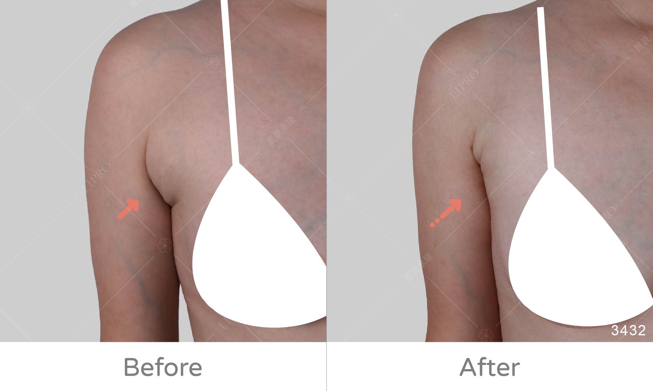 顯微套管抽脂案例、副乳抽脂手術案例成果展示