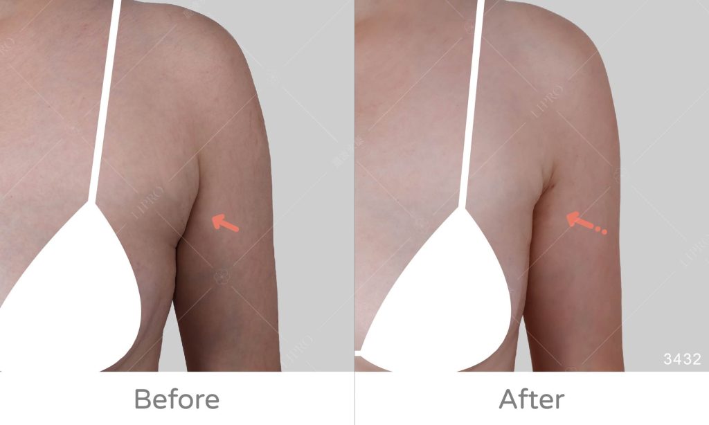 正面角度紀錄副乳抽脂成效，腋下副乳細節處理放大展示