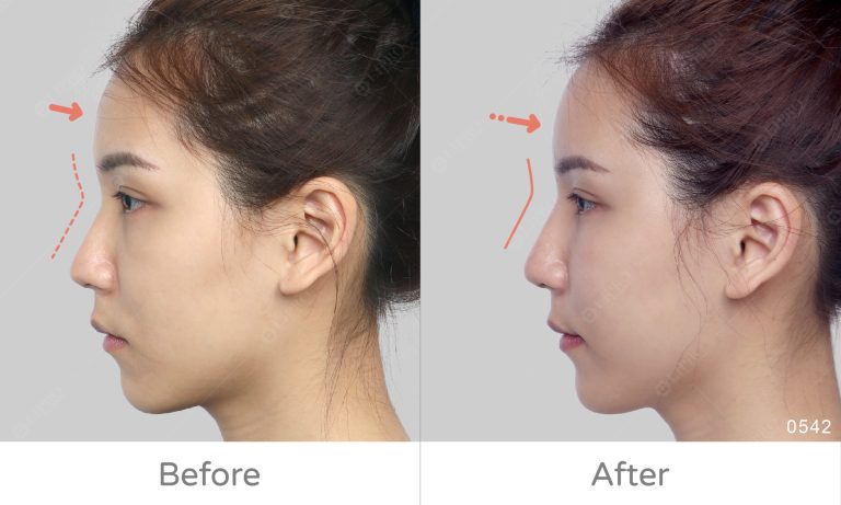 顯微套管抽脂術ft.精微自體脂肪移植槍，自體脂肪補臉案例