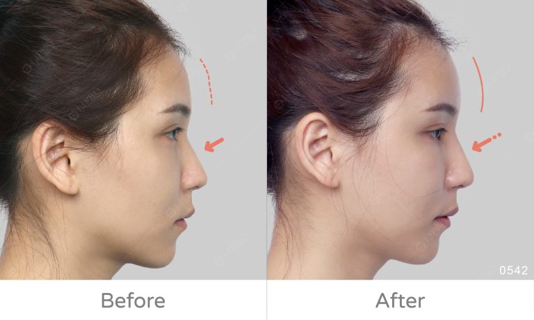 臉部補脂更年輕，顯微套管抽脂術ft.精微自體脂肪移植槍