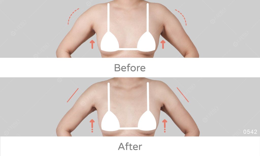 顯微套管抽脂手臂加上前後副乳的處理，讓整體背影更加細緻