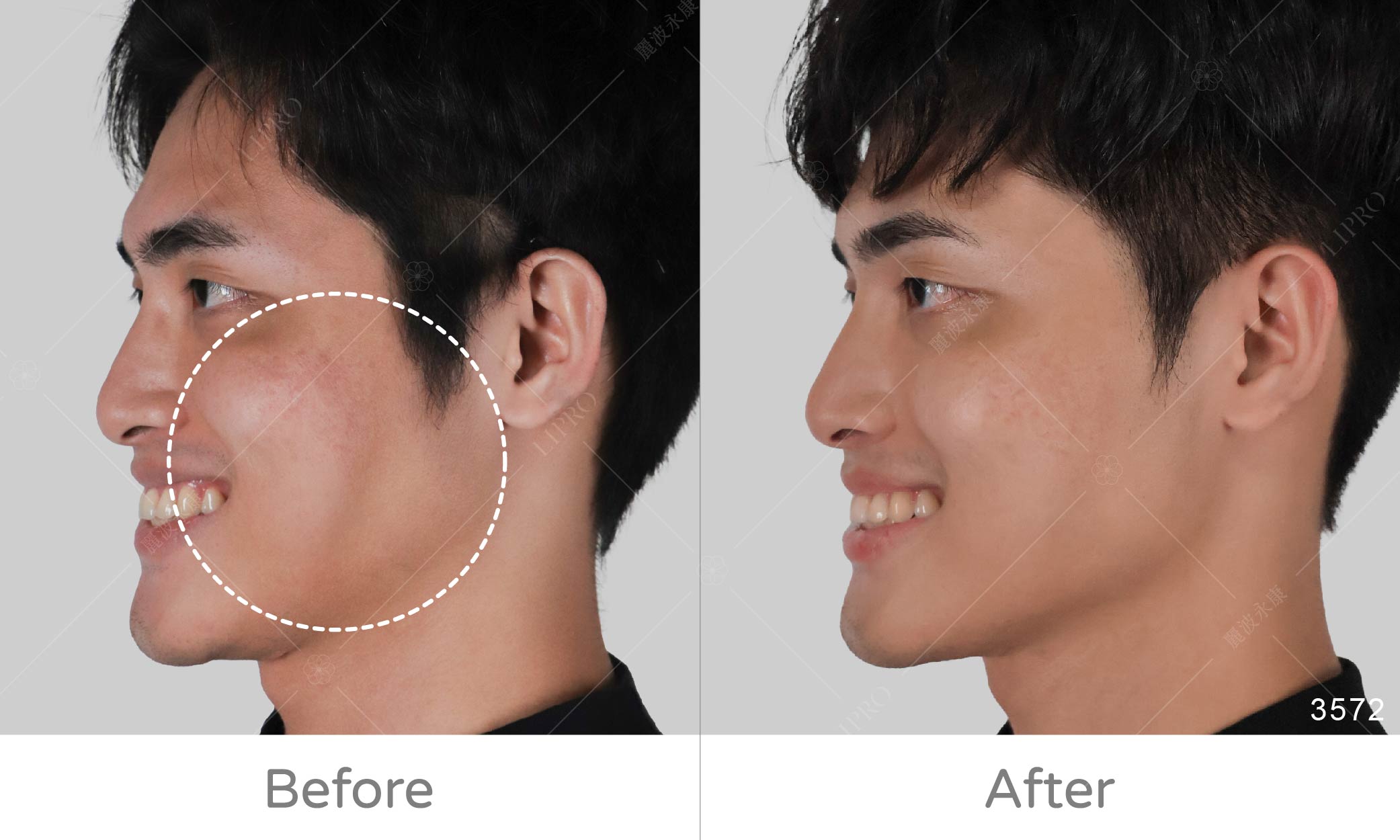 顯微套管精緻自體脂肪補臉術後成效，側面角度微笑效果