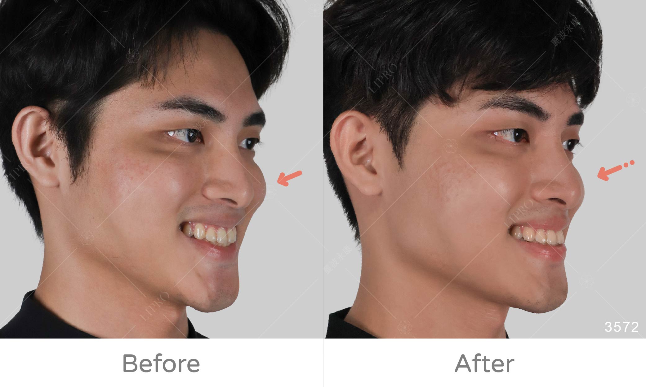 顯微套管精緻自體脂肪補臉術後成效，側面角度蘋果肌減量