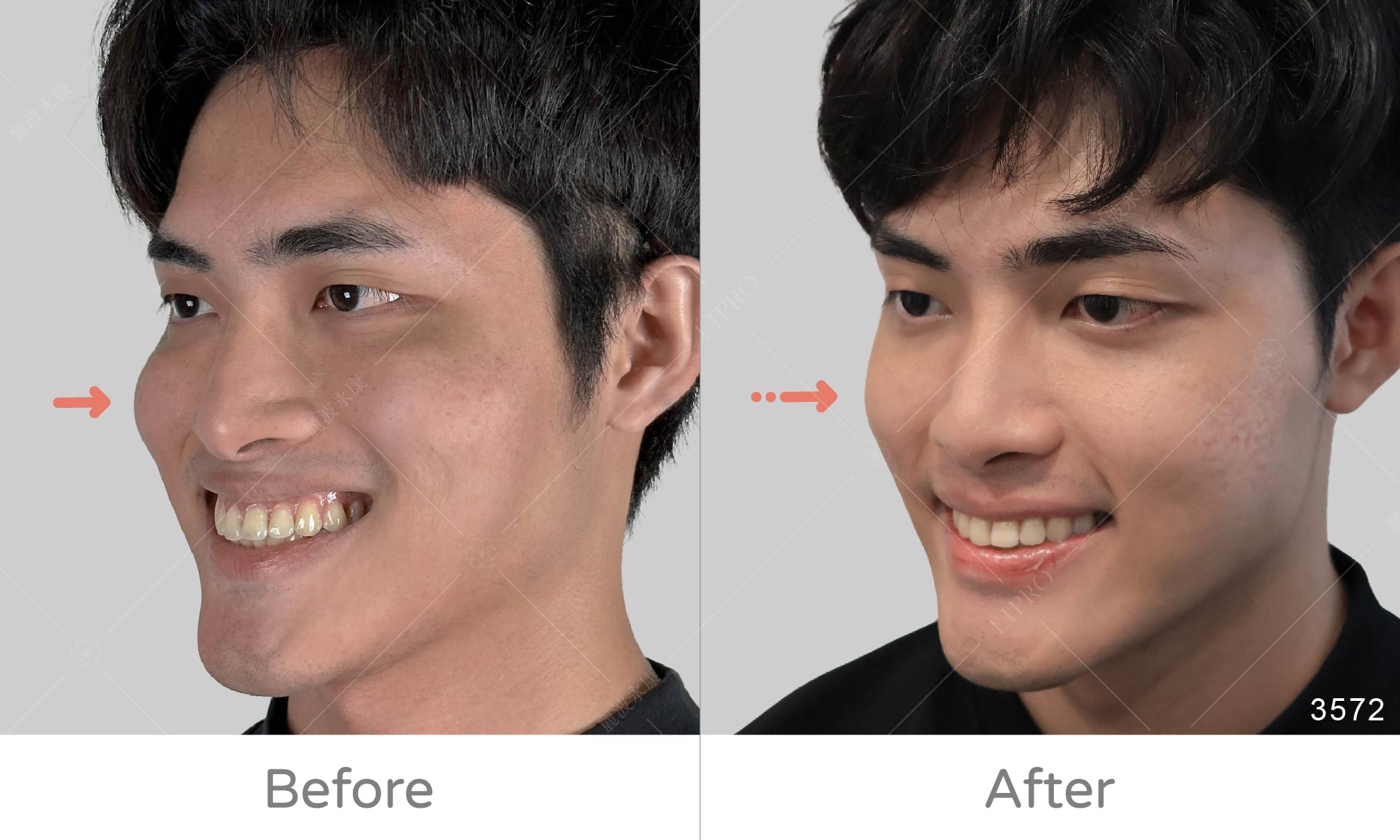 顯微套管精緻自體脂肪補臉術後成效，側面角度蘋果肌減量