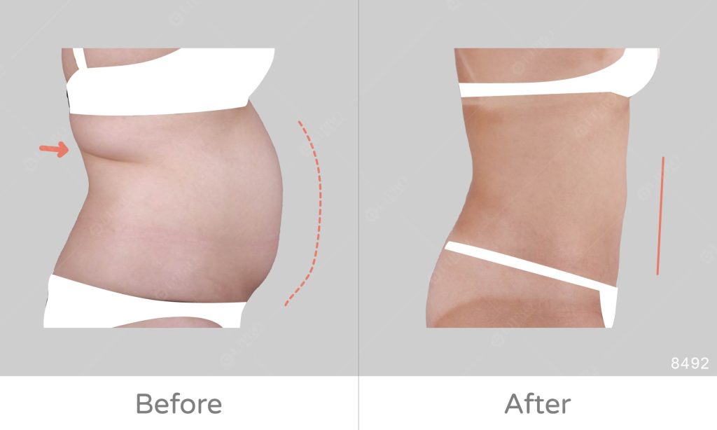 第一次腰腹抽脂案例，麗波永康顯微套管抽脂手術術後不需穿塑身衣