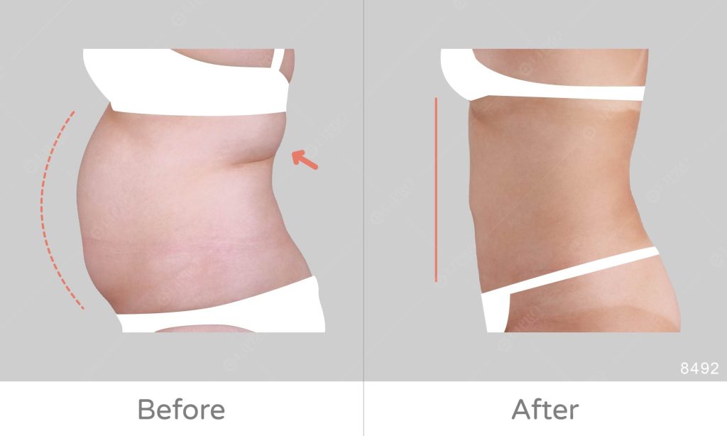 麗波永康國際診所腹部抽脂評價、不須穿塑身衣的抽脂選擇