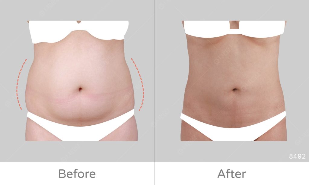 顯微套管腹部抽脂案例分享、麗波永康國際診所腹部抽脂評價