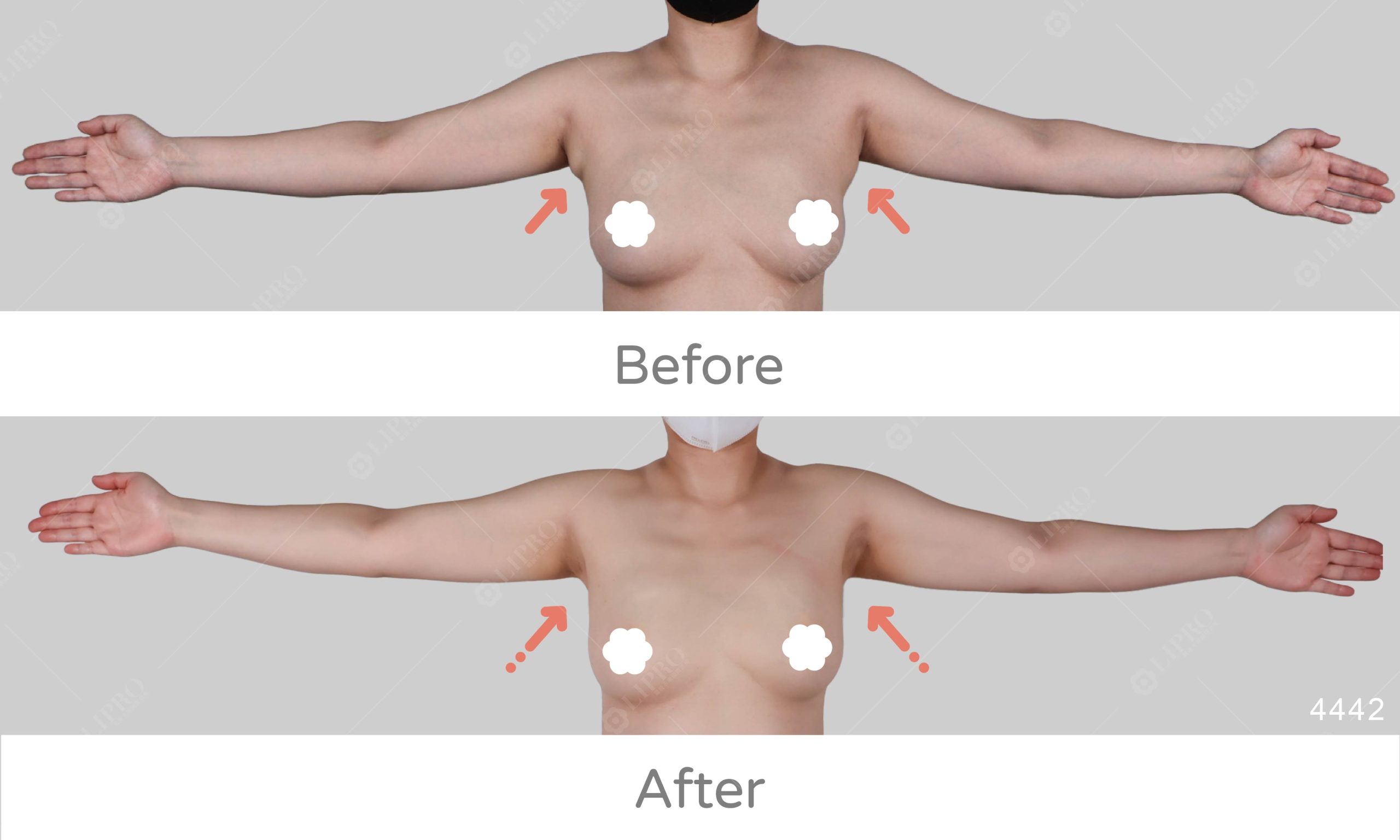 副乳消除選擇麗波永康顯微套管抽脂手術，不須穿塑身衣、術後恢復快