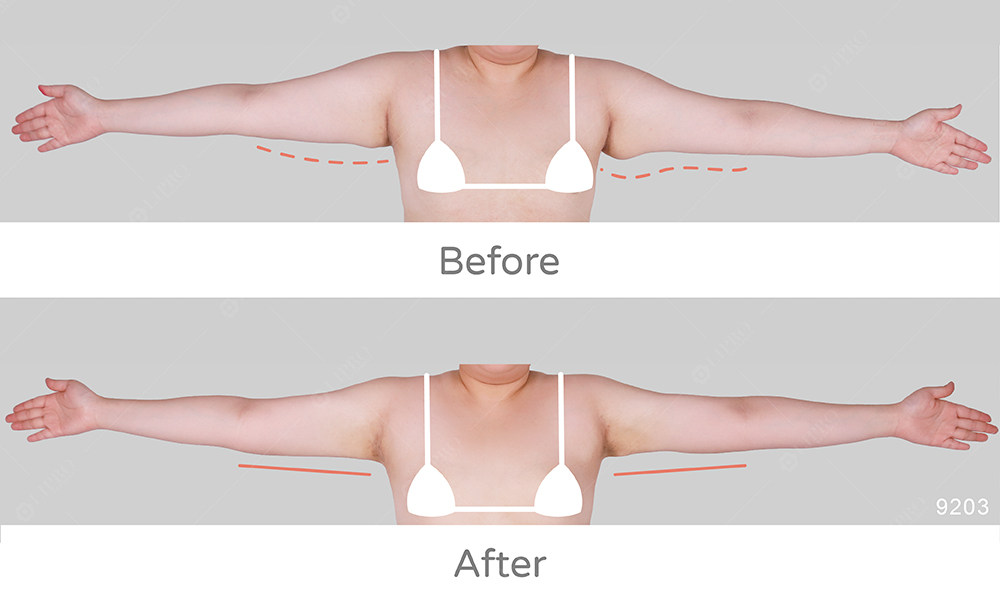 個案的手臂皮膚經過顯微套管精緻抽脂後不須穿塑身衣，也能達到皮膚自然回彈效果