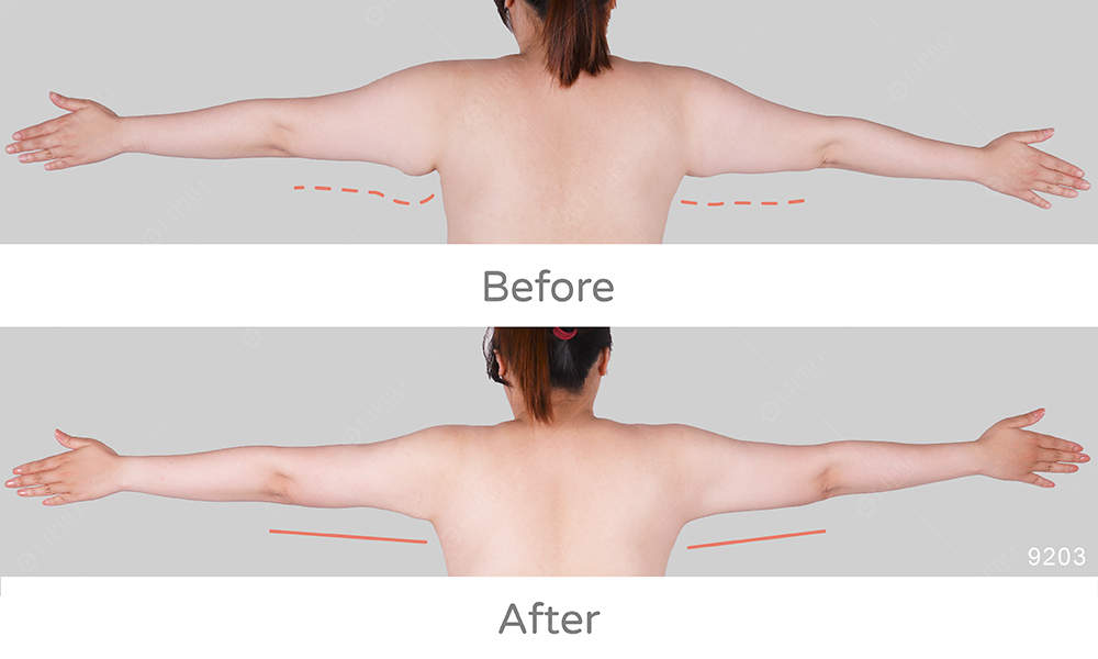 左右手臂形狀不對稱的情況該怎麼辦?顯微套管抽脂手術可以精準調整手臂曲線