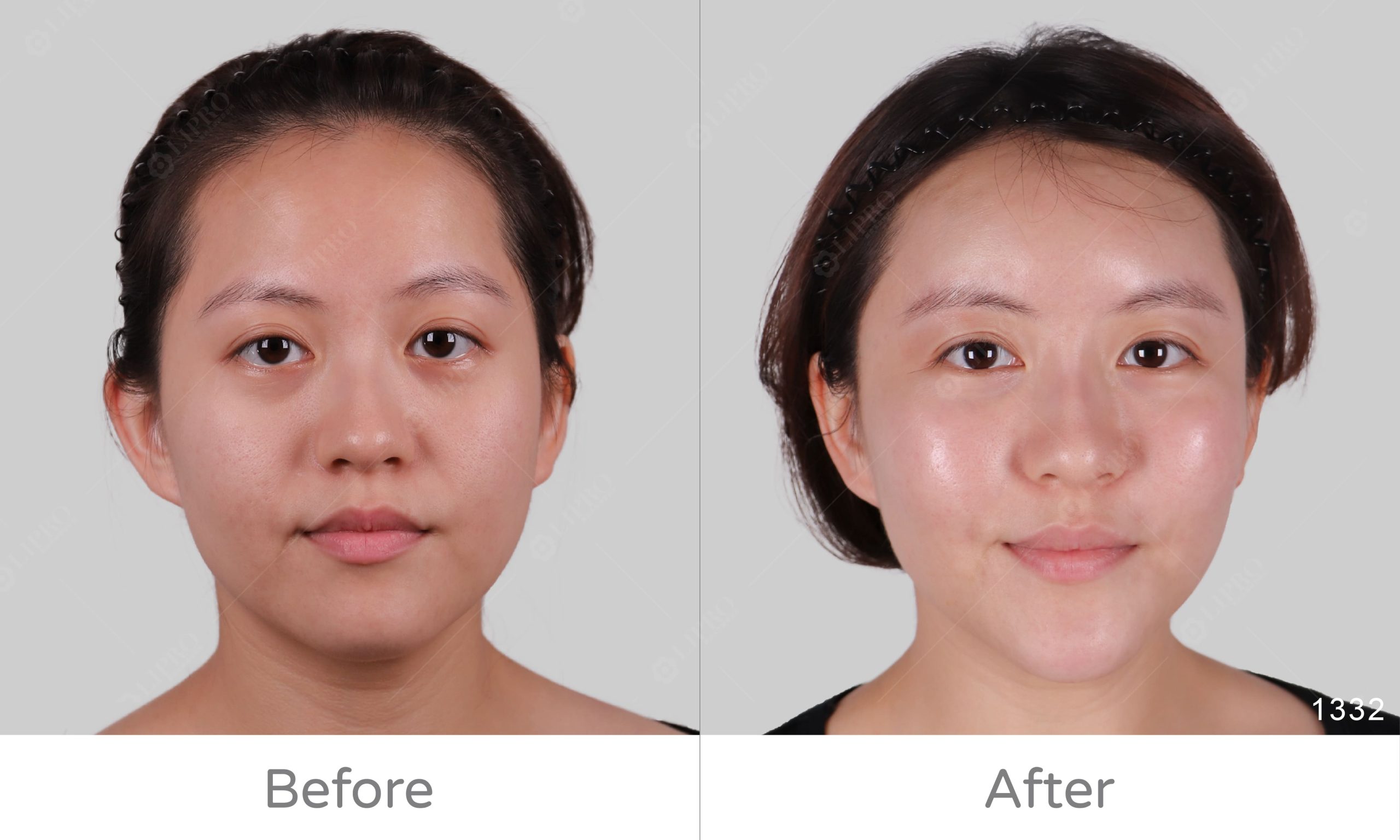 麗波永康全臉補脂案例分享，精緻脂肪成就青春臉龐