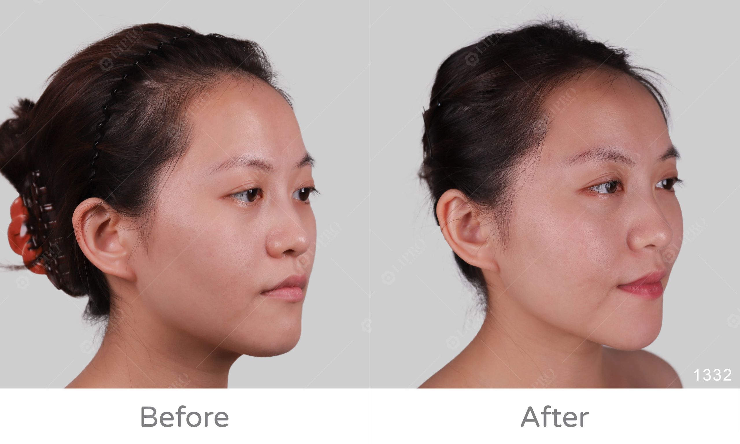 顯微套管自體脂肪移植補臉BA、麗波永康全臉補脂案例分享