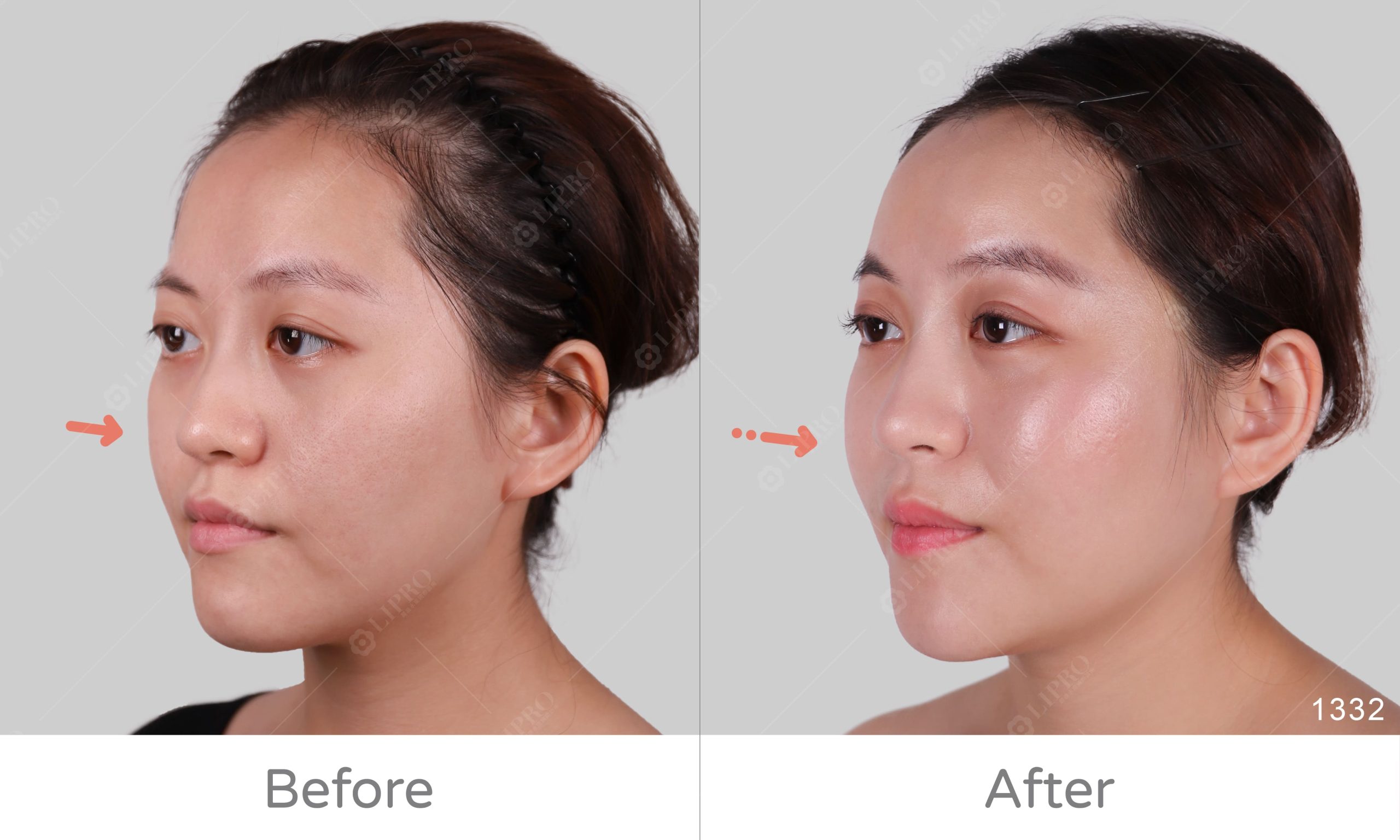 顯微套管自體脂肪移植補臉BA、麗波永康全臉補脂案例分享