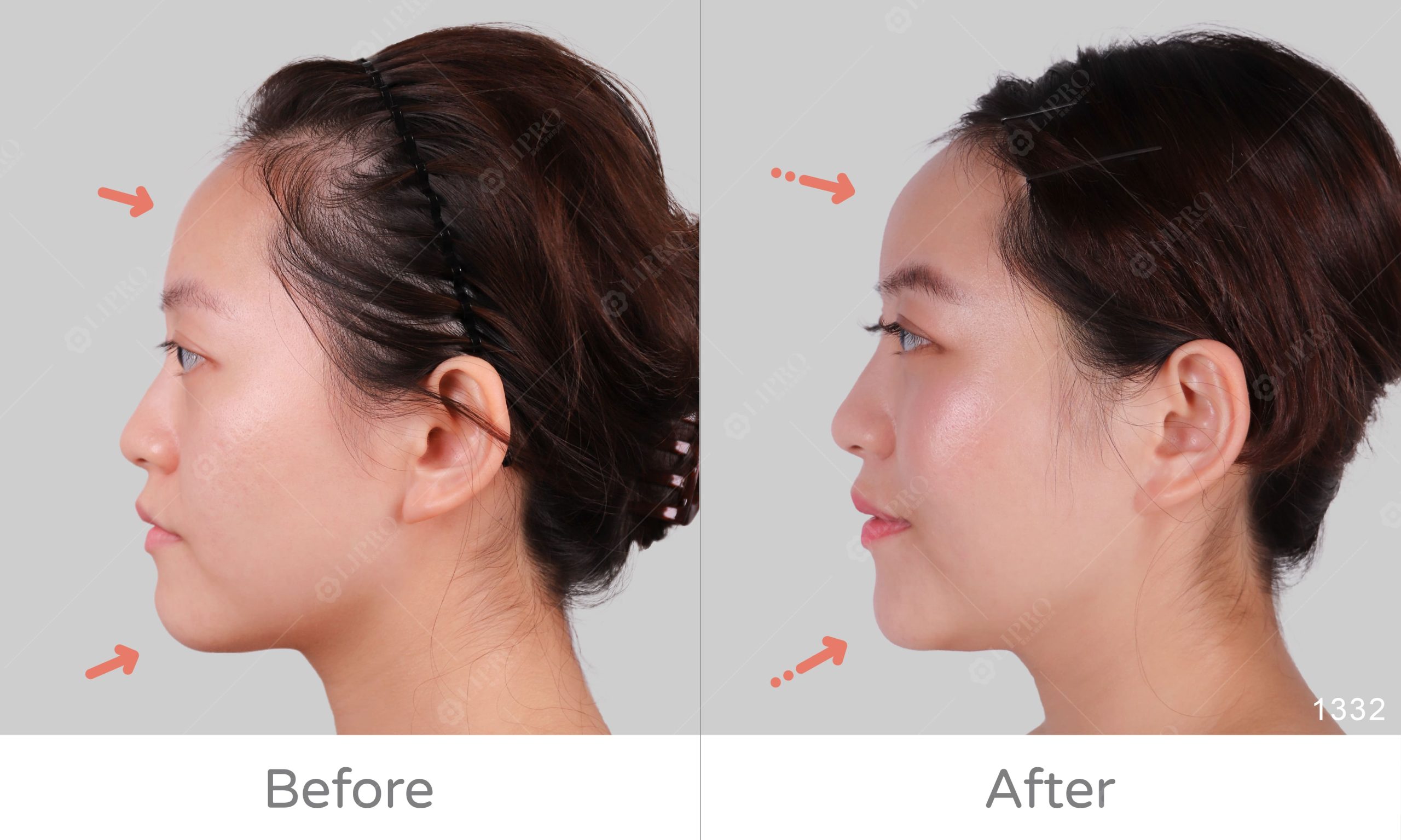 顯微套管自體脂肪移植補臉BA、麗波永康全臉補脂案例分享