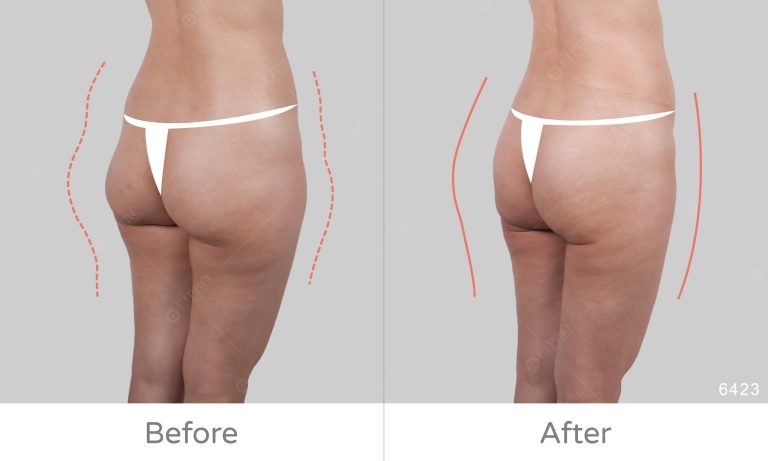 顯微套管大腿外側抽脂、臀部曲線精緻抽脂
