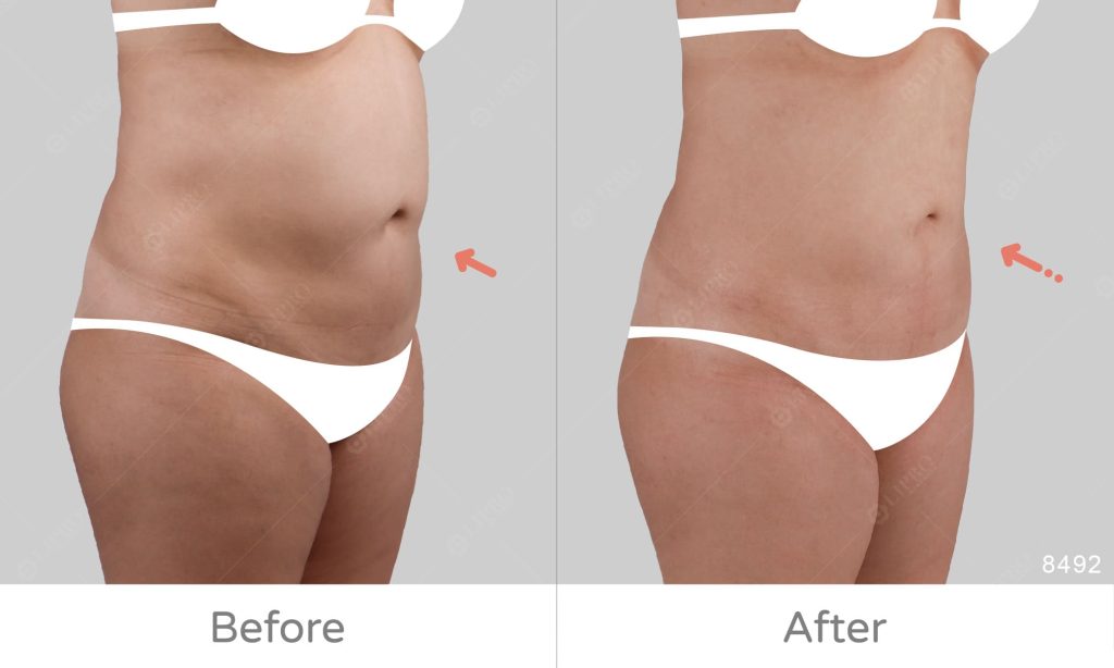 麗波永康腰腹抽脂二次重修案例，重修術後腹部凹凸陰影消失