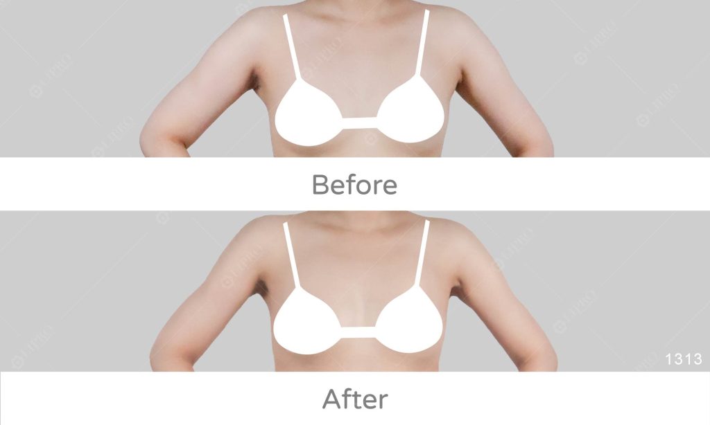 個案本身全身組織比較軟、脂肪跟皮膚會有很大的晃動，選擇增加電漿來增加皮膚的緊緻度