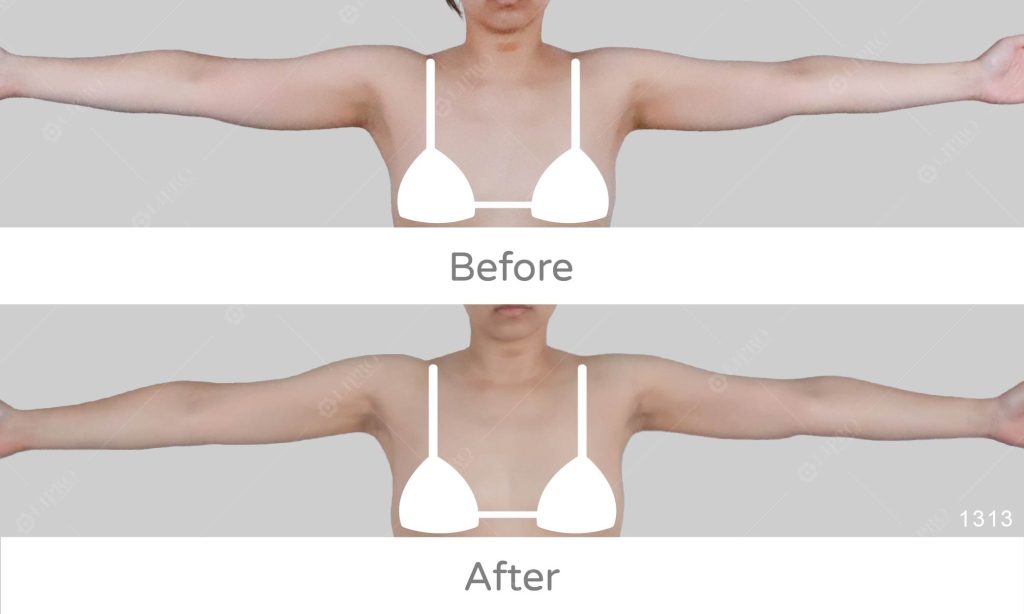 顯微套管手臂精緻抽脂，搭配超能漿增加手臂皮膚的緊緻度