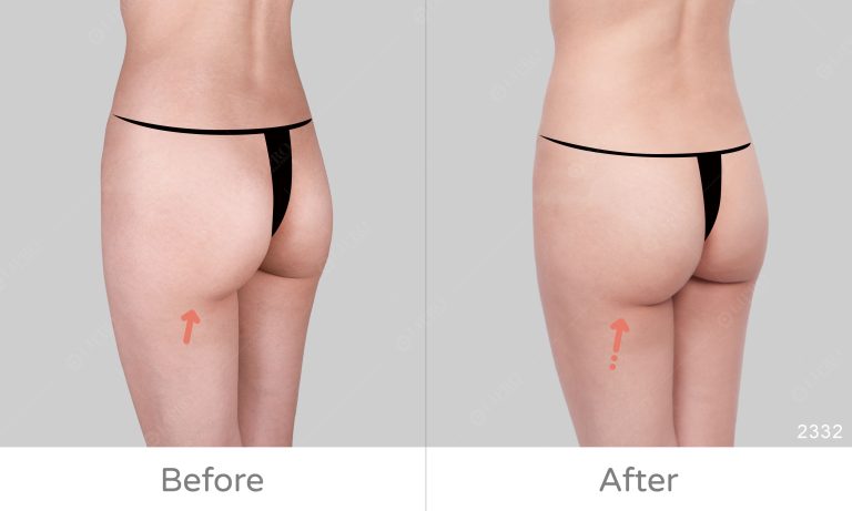 麗波永康抽脂專家李咏馨醫師專擅顯微套管抽脂、臀部抽脂可選擇清醒手術、不須全身麻醉更安心