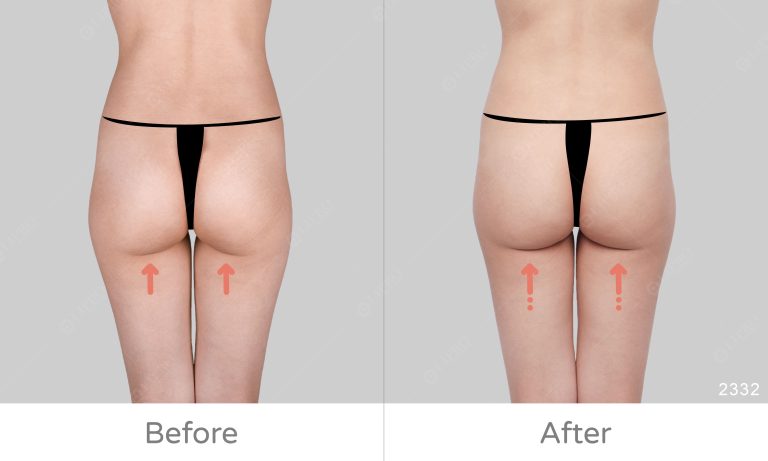 顯微套管抽脂可選擇清醒麻醉，精緻調整臀部微笑線、術後免穿塑身衣