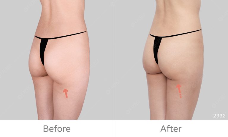 顯微套管臀部抽脂案例分享，不須全身麻醉更安心、術後免穿塑身衣