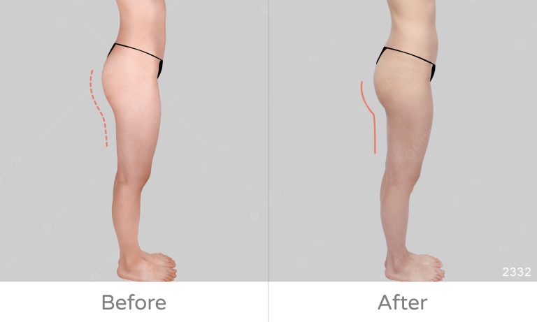 臀腿抽脂案例分享，顯微套管抽脂可選擇清醒麻醉、術後不需穿塑身衣