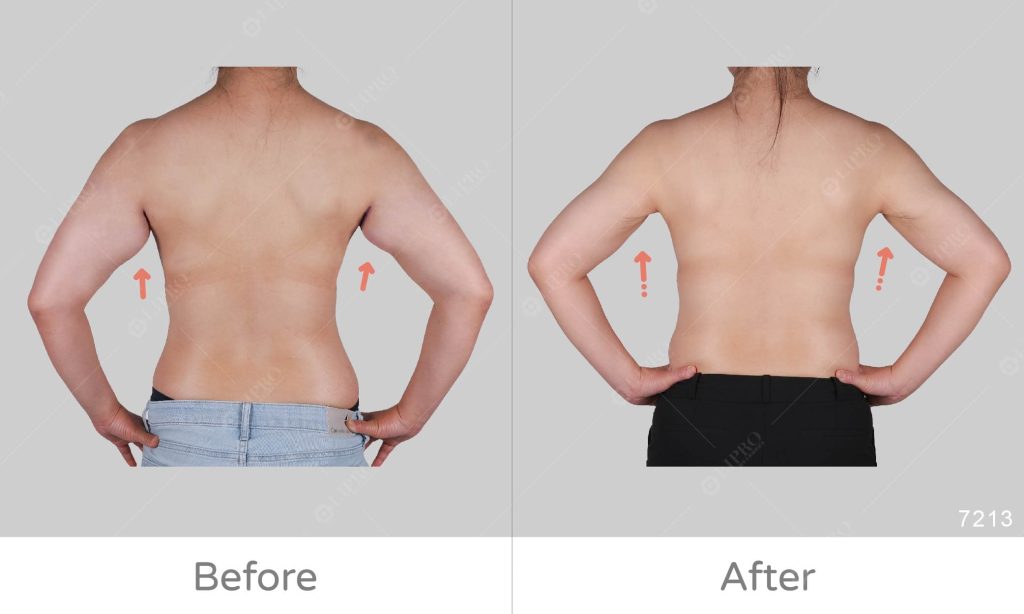 手臂蝴蝶袖抽脂案例分享，顯微套管實際案例術後成果展示