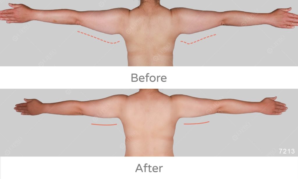 麗波永康專業抽脂醫美診所，顯微套管抽脂手術擺脫蝴蝶袖、不須穿塑身衣更輕鬆