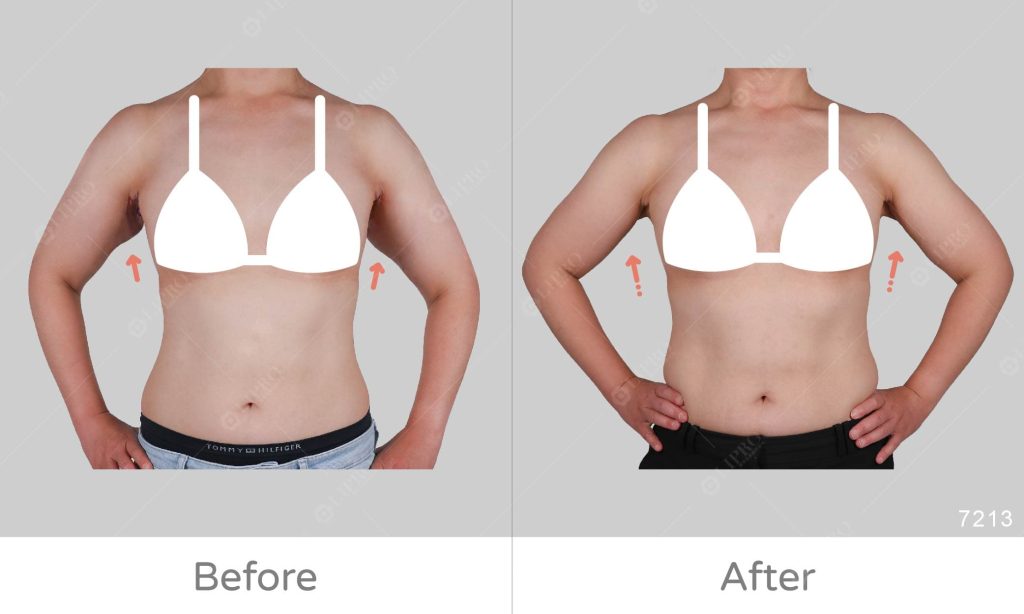 顯微套管精緻手臂抽脂案例成果，麗波永康專業抽脂醫美診所，輕鬆擺脫蝴蝶袖