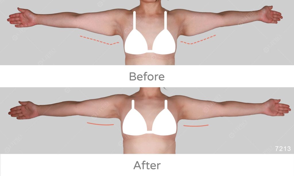 顯微套管手臂蝴蝶袖抽脂案例術後成果展示，術前術後成果比對圖