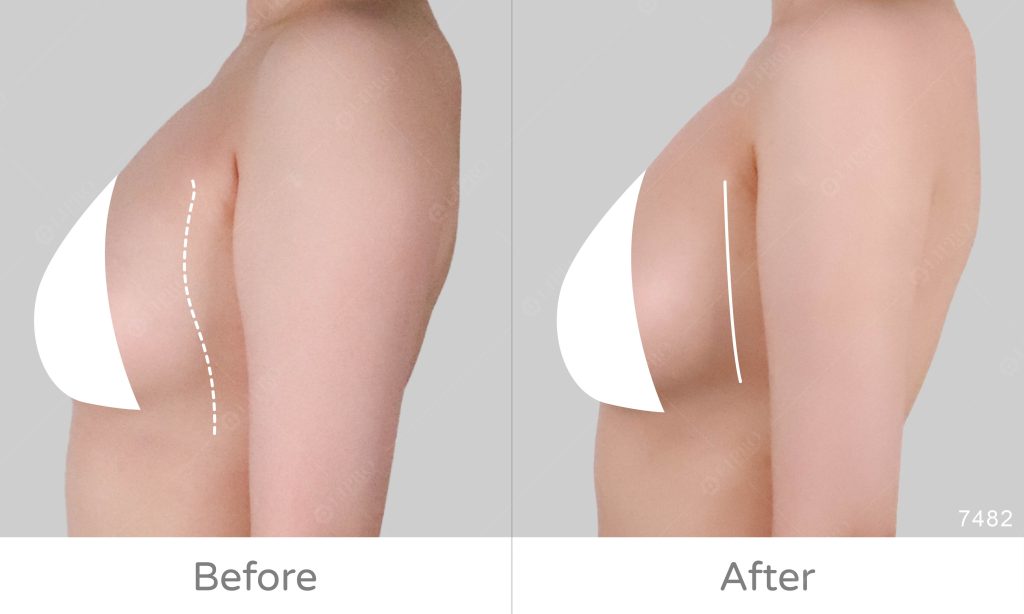 手臂360度整體雕塑的處理，內側跟前側一樣重要，安全性要求必須更高