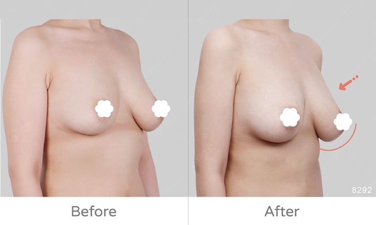麗波顯微套管自體豐胸，術後效果自然、傷口幾乎隱痕