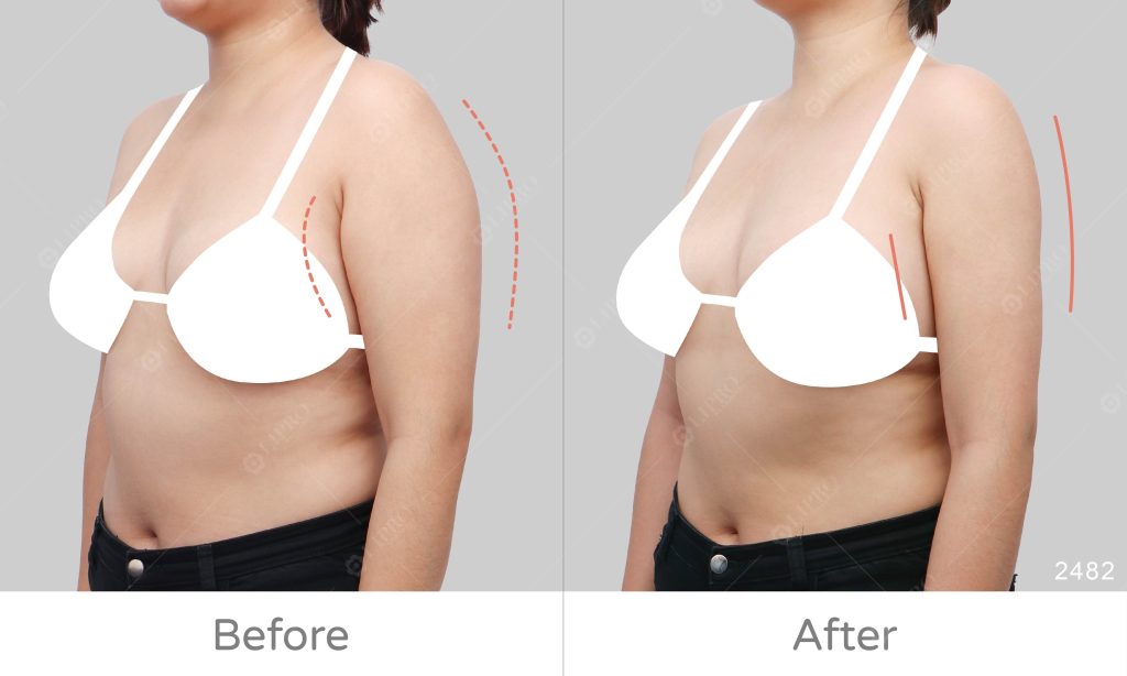 手臂精緻抽脂、手臂肌肉明顯案例顯微套管術後成果展示