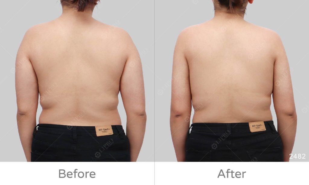 個案手臂有脂肪囤積的問題，且手臂肌肉量較大，選擇顯微套管抽脂其中原因就是不需穿塑身衣且恢復快速