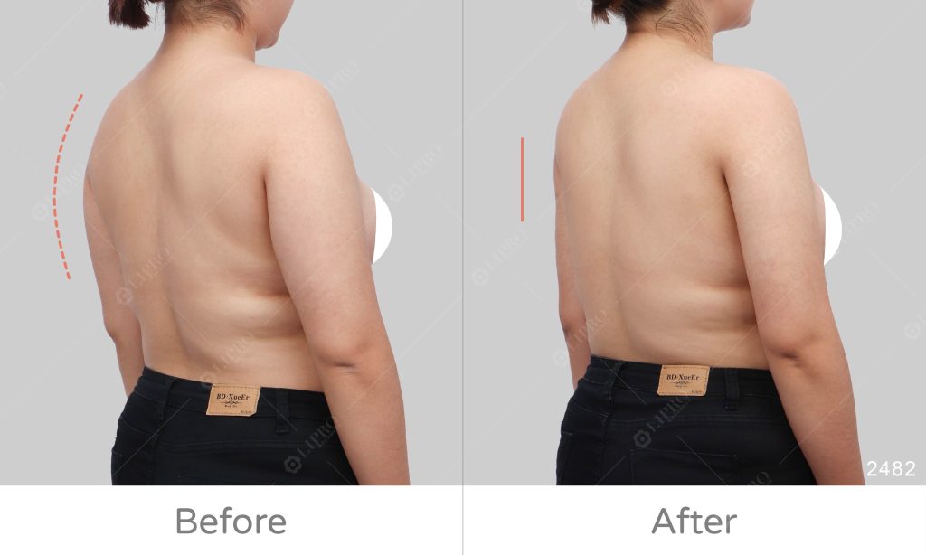 個案本身有重量訓練的習慣，選擇顯微套管抽脂除了不用穿塑身衣，另外就是恢復快，術後一週就回復原本的運動