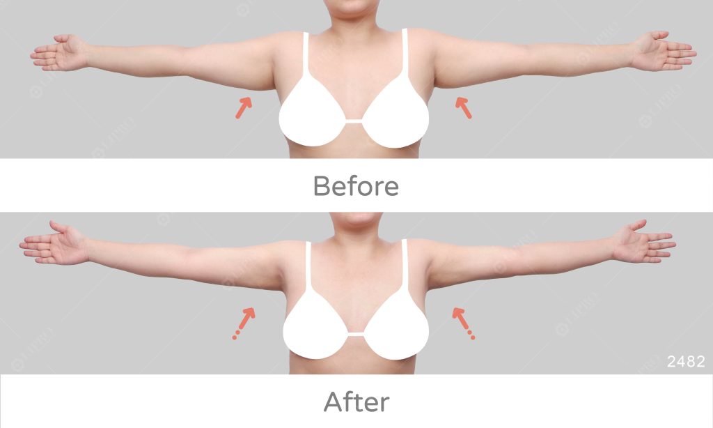 顯微套管抽脂除了不用穿塑身衣，另外就是恢復快，術後一週就回復原本的運動