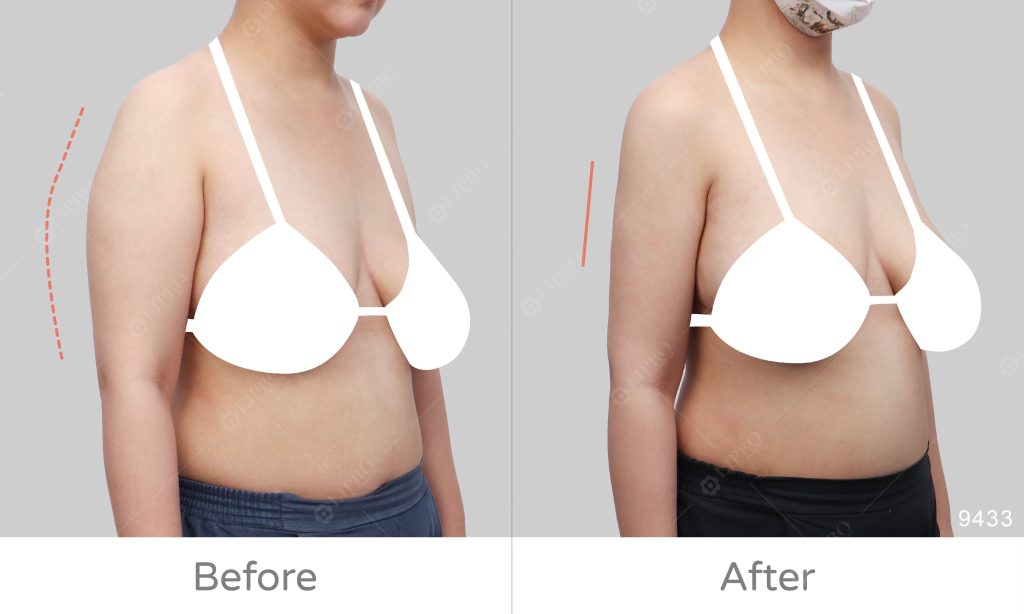 副乳不夠精緻、平舉時的手臂皮膚收縮、以及脂肪囤積在手臂三角肌上方的位置