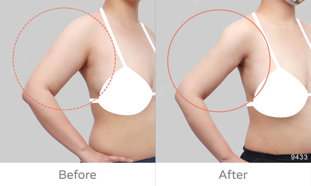 透過顯微套管抽脂精緻抽脂緊縮式的抽脂方式，重新雕塑手臂型態及皮膚形狀