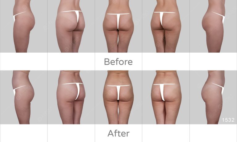 臀部抽脂案例術前術後多角度對比圖，顯微套管抽脂術後成效展示