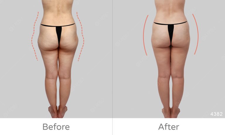 麗波臀腿抽脂案例好評分享，大腿外側經顯微套管抽脂修飾後曲線平順