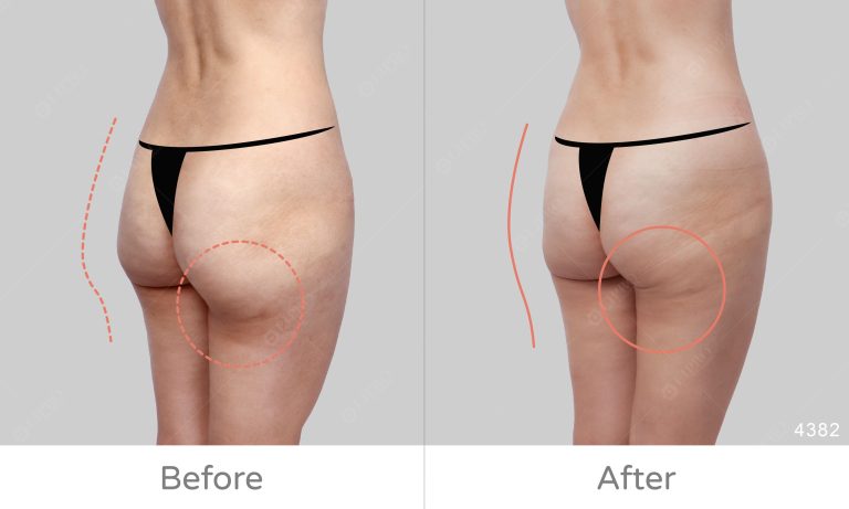 臀線修飾、臀部微笑線精緻抽脂大滿意、臀部抽脂案例分享