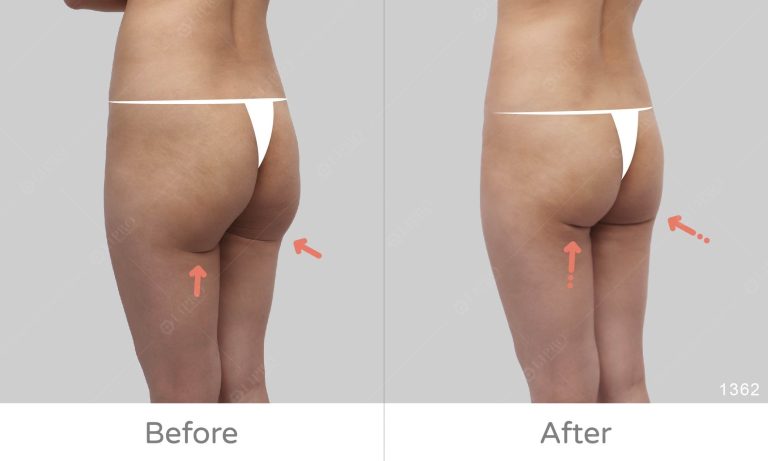 顯微套管重修手術拯救下垂的臀線、微笑線修復拯救案例分享