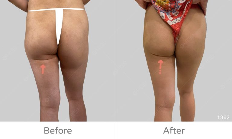 顯微套管重修術後成果分享、微笑線下垂修復拯救案例