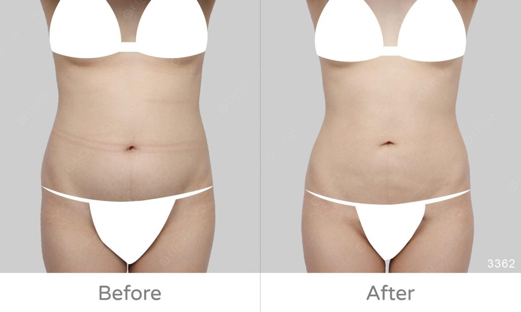 腰腹抽脂好評推薦，顯微套管腹部環抽案例分享