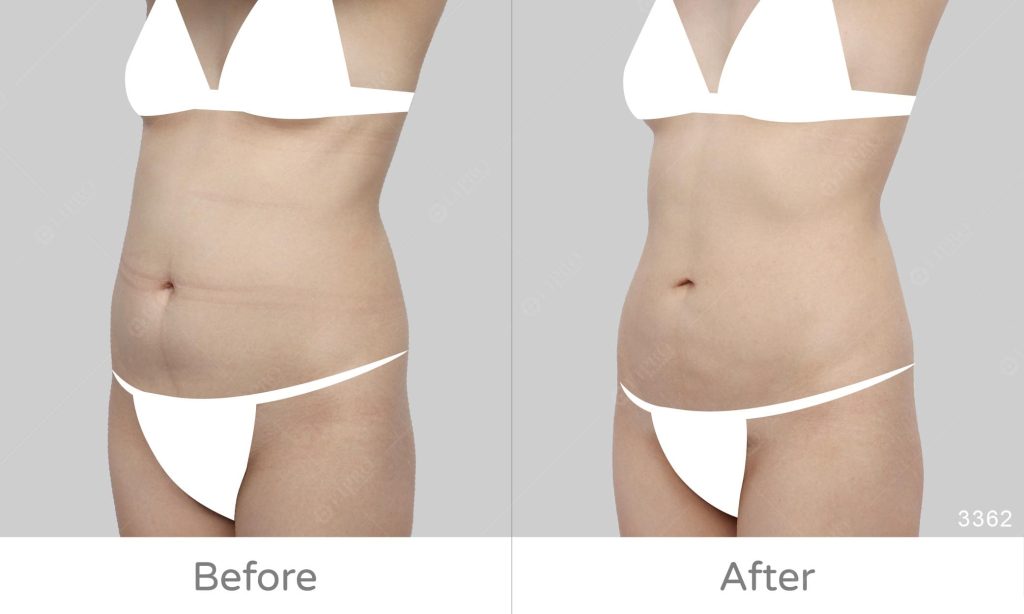 精緻抽脂專家李咏馨醫師、腰腹抽脂案例豐富經驗，顯微套管抽脂術後不需塑身衣