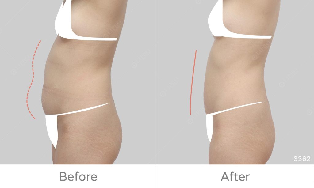 顯微套管腹部抽脂案例，術後不需穿塑身衣、照護更方便，日常活動不受限