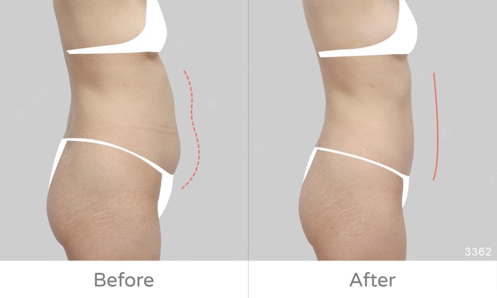 麗波永康腰腹抽脂大量案例，顯微套管抽脂案例分享，術後改變明顯