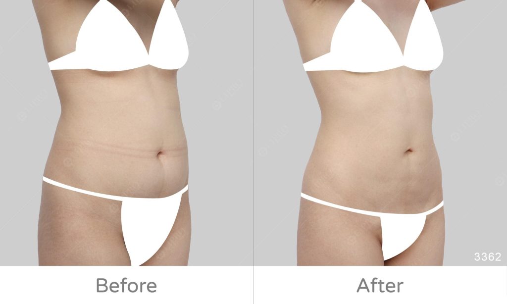 顯微套管腹部精緻抽脂案例分享，術後不需穿塑身衣、術後照護更輕鬆