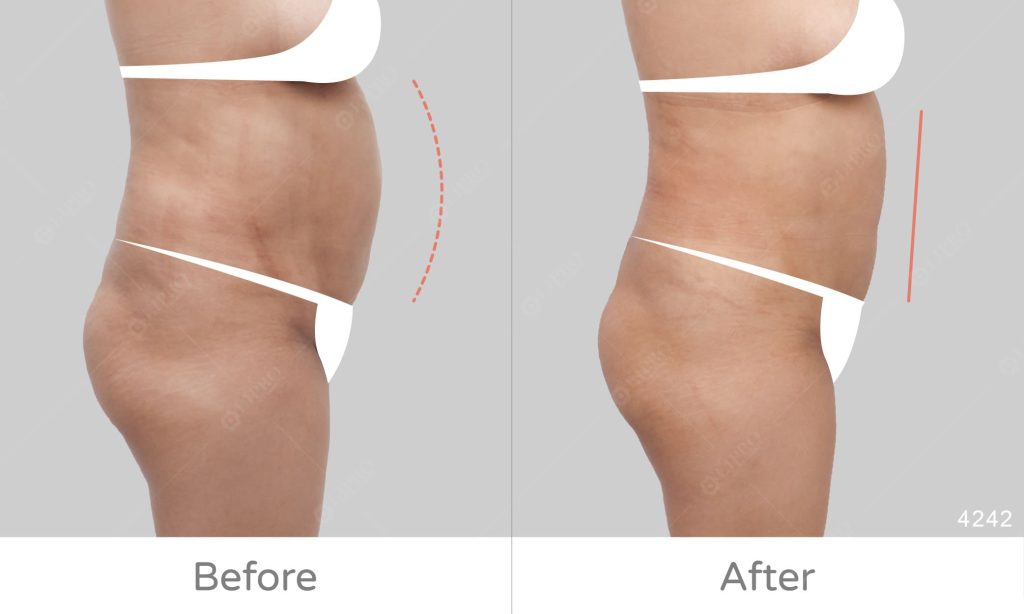 顯微套管腰腹抽脂成效明顯，側面展示麗波腰腹抽脂成果