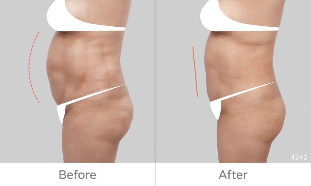 麗波永康腰腹抽脂案例分享，顯微套管腰腹抽脂術前術後對比、抽脂成效明顯